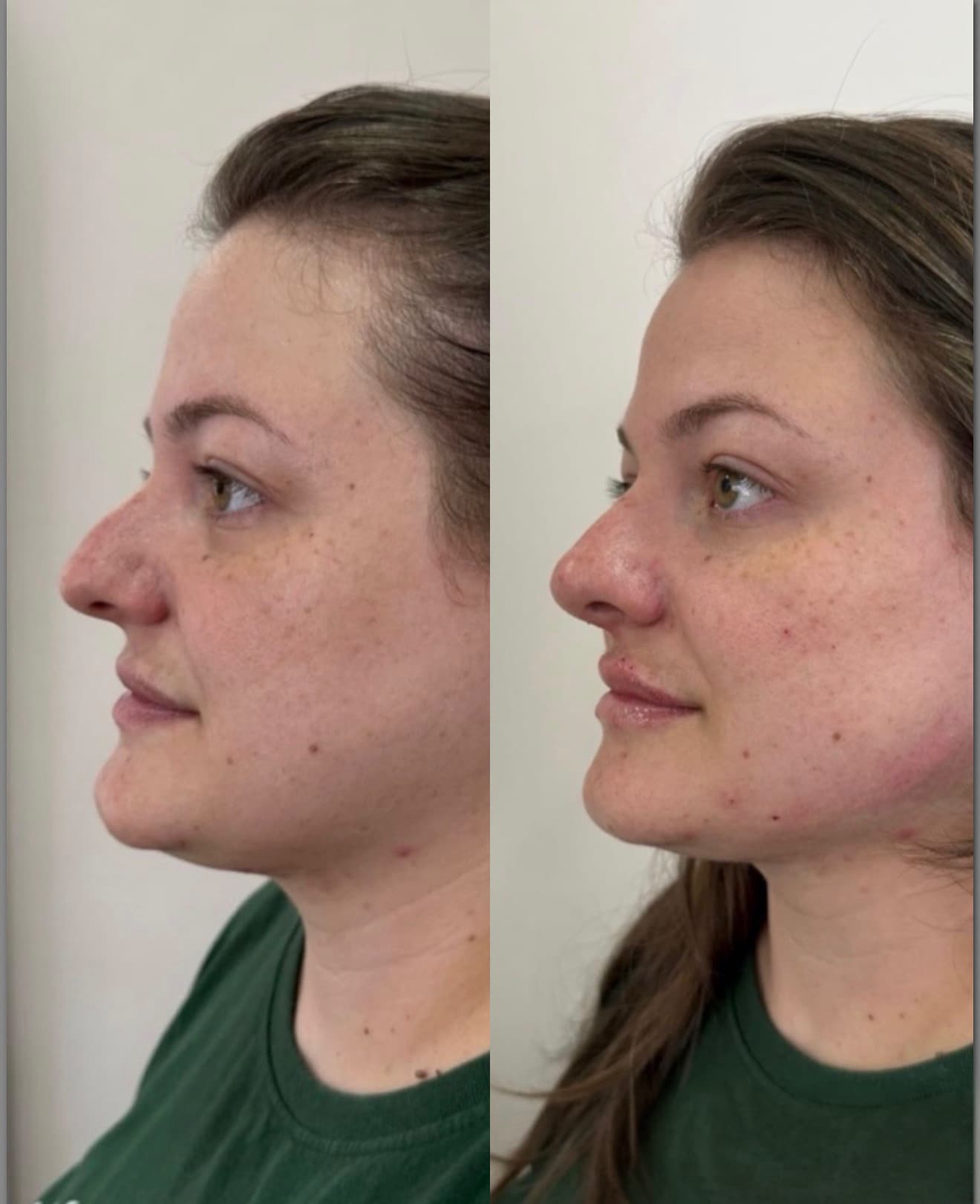 Antes e depois — Rinomodelação + preenchimento labial + contorno mandibular
