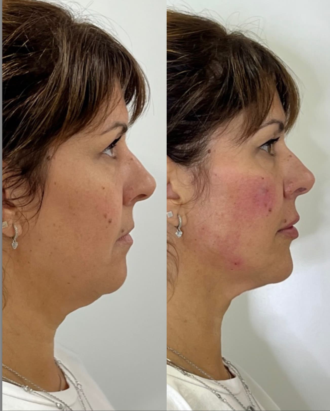 Antes e depois — Lipo de papada + preenchimento de mento