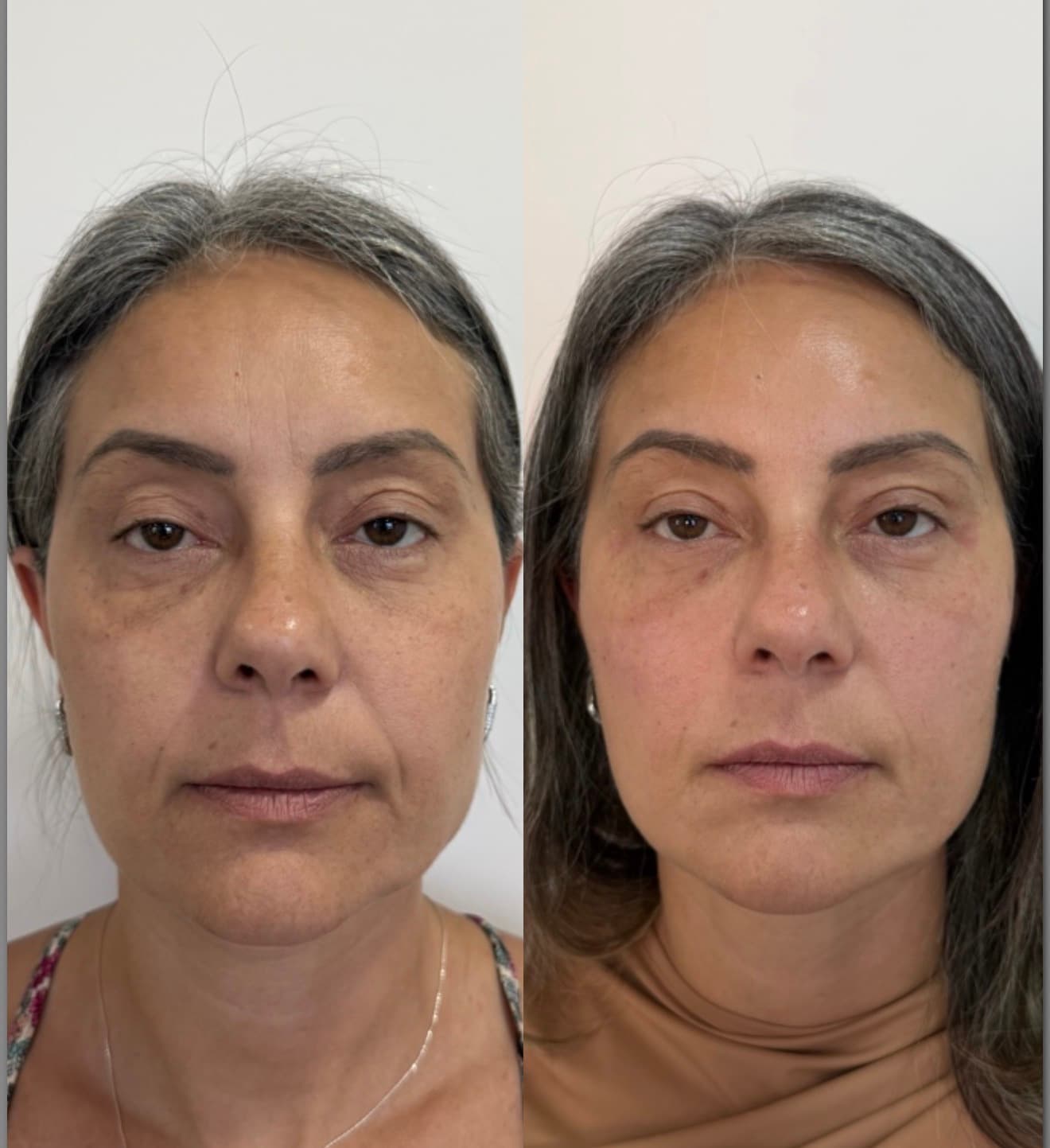 Antes e depois — Preenchimento de olheiras + PDRN
