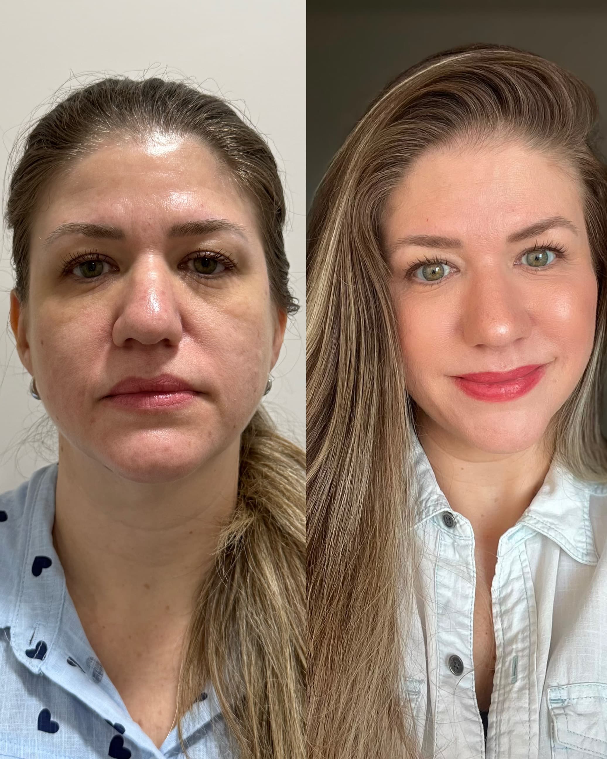 Antes e depois — Método Renascē